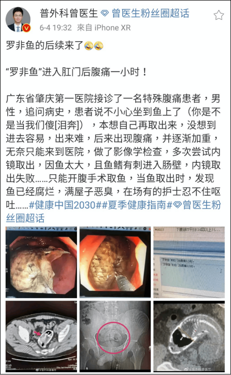 肛门|医生在直肠里找到了啤酒杯、罗非鱼、茄子、灯泡、泥鳅.....