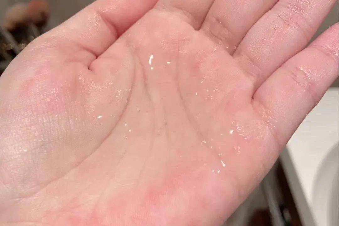 根源|三层遮瑕都遮不掉这烦人的痘印？不如就从根源下手！