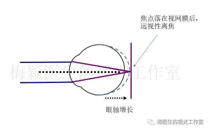 人均近视度数_近视度数对照表(2)