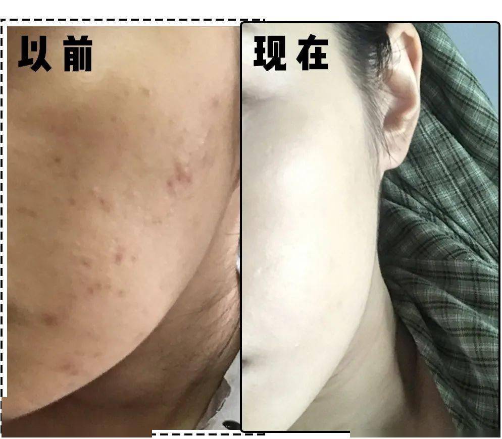 护肤|经常挤痘痘的女生，都是这个下场！（真人实测）