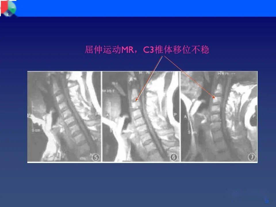 颈椎病影像再认识