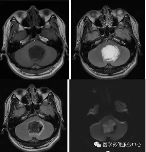 ④脑桥小脑角池,环池,四叠体池的肿瘤可致脑干受压,变形.