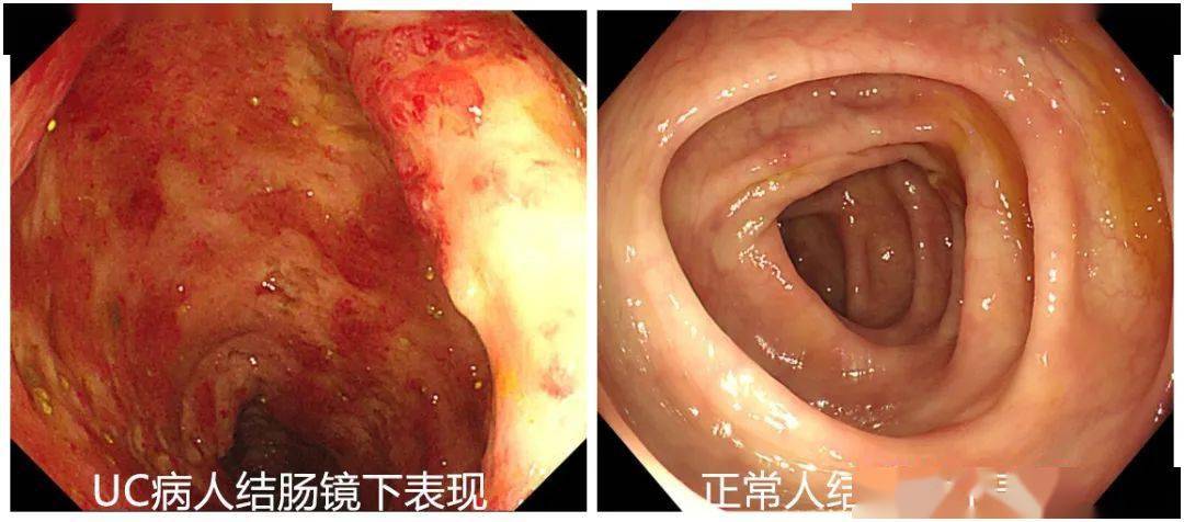 严重时一天腹泻30次让安倍晋三辞职的溃疡性结肠炎究竟有多可怕