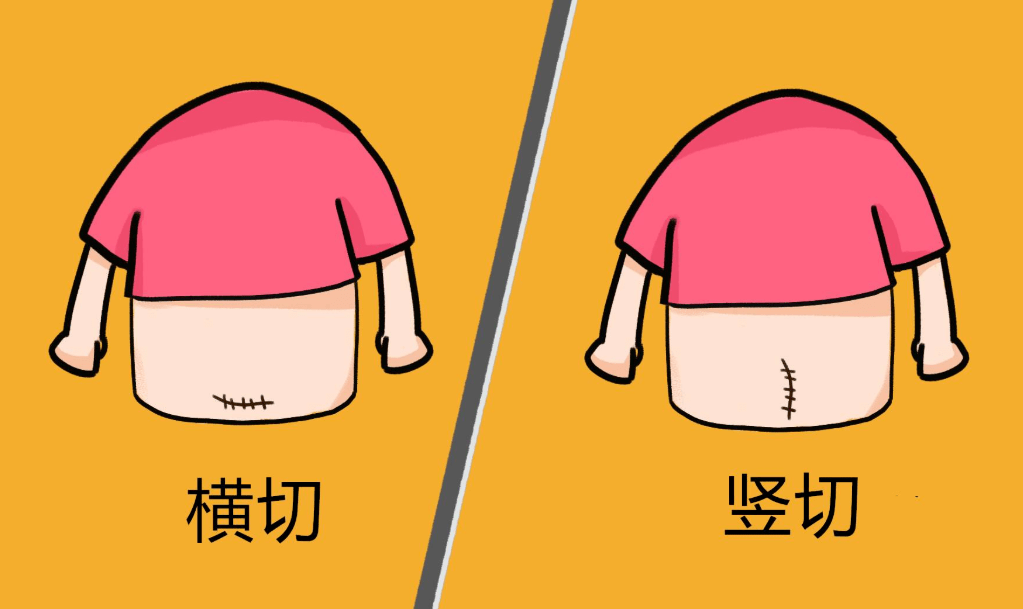 如果是撕裂伤…则会比平整的侧切伤口恢复时间更长些.