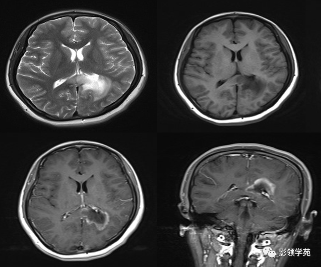大脑胶质瘤病影像学诊断