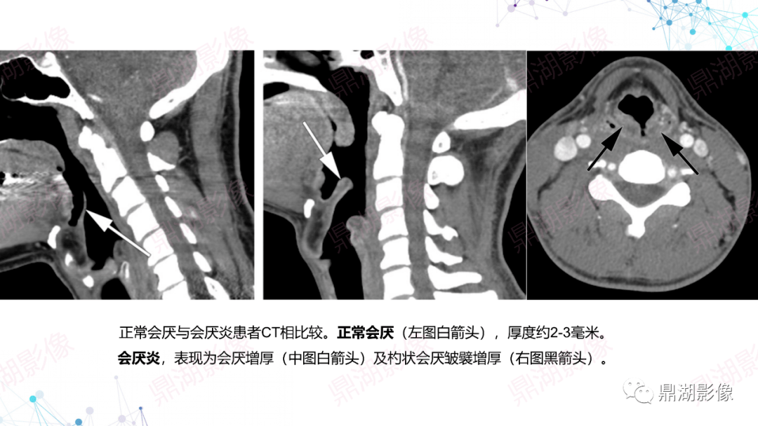 右侧恶性外耳道炎影像表现阅片的基础是解剖,颈部解剖精细繁杂,既往