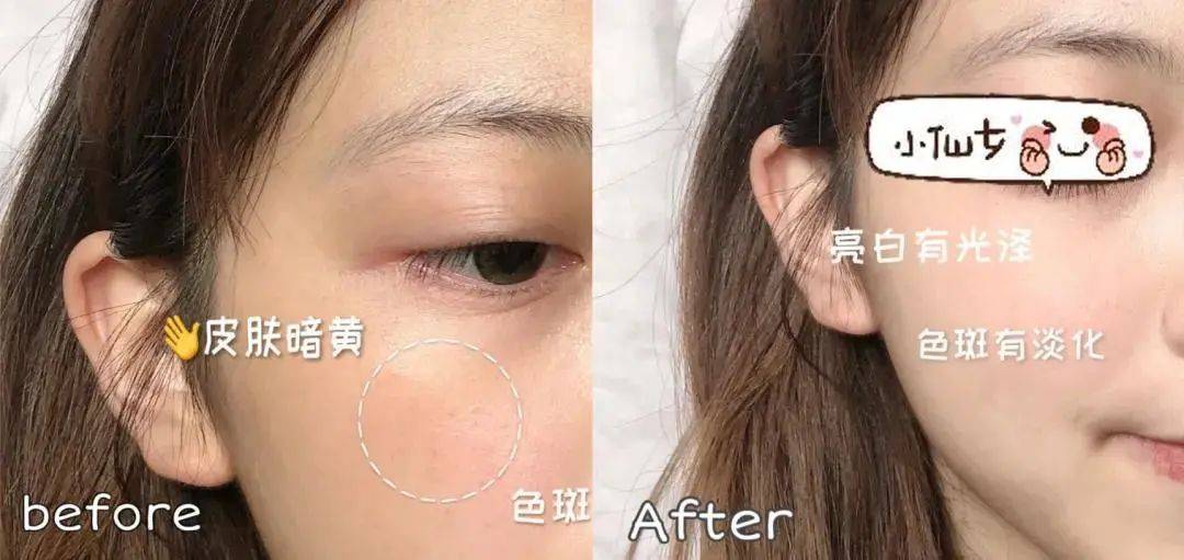 贫民窟|杨幂熬夜后护肤要花2万块？怪不得皮肤吹弹可破！贫民窟女孩就不配消除熬夜痘、黑眼圈吗？