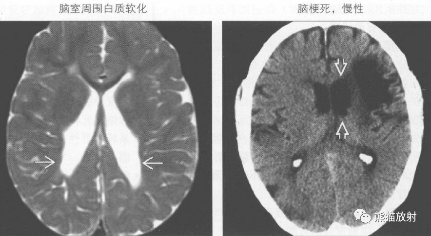 鉴别诊断丨侧脑室不规则