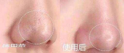 痘痘|夏天变黑长痘不可怕，赶紧用它，让你的皮肤恢复婴儿的光滑，痘痘，黑头，螨虫全都消失了