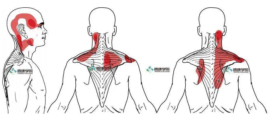 肌肉疗法|斜方肌损伤_肩胛骨