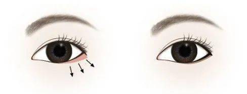 双眼皮|为什么“整容脸”女孩,更受直男欢迎?