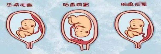 胎儿头位置太低怎么办