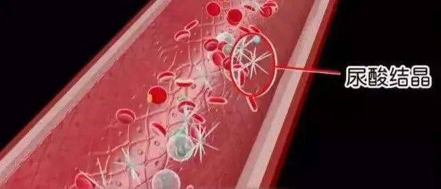 血管|人体最痛的六种病，痛风仅排第五！希望你一个都没经历过