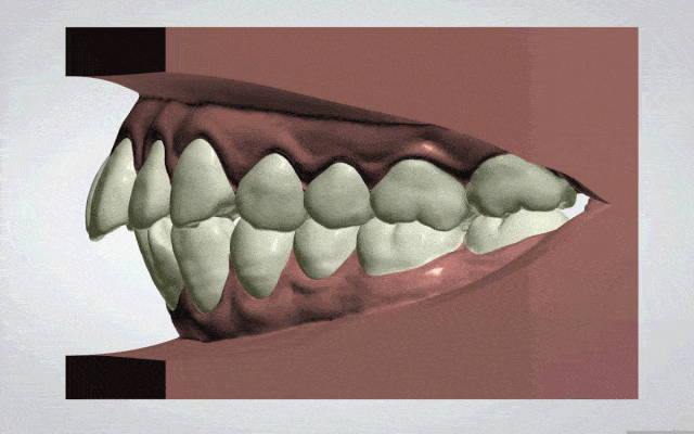隐形牙套每半个月换一副新的,相当于半个月调整一次牙齿的位置,可以