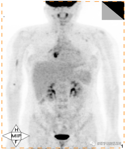 规培朋友看过来--核医学病例及解析(183号)