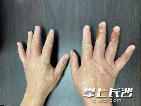 白果|曾有孩子因此丧命扩散！别碰路边这种果子！多地有人中招