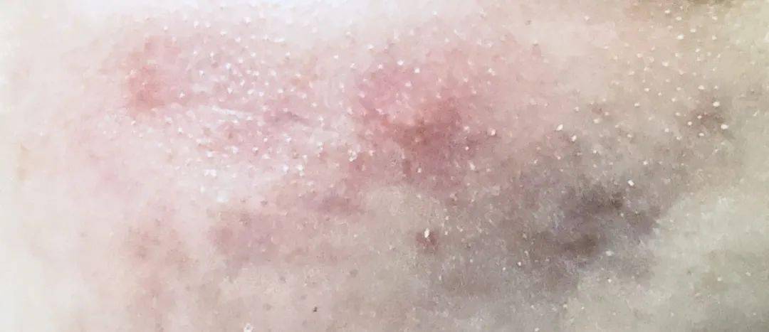 张天|长期闭口、粉刺、痘痘满脸的人，微镜头下毛孔竟然是这样的！赶紧get林允、张天爱的0毛孔秘籍吧！