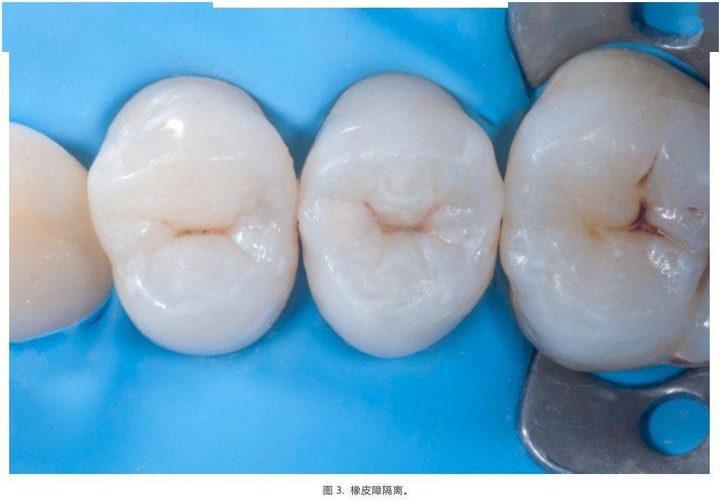 病例分享前磨牙根管治疗后的高嵌体修复