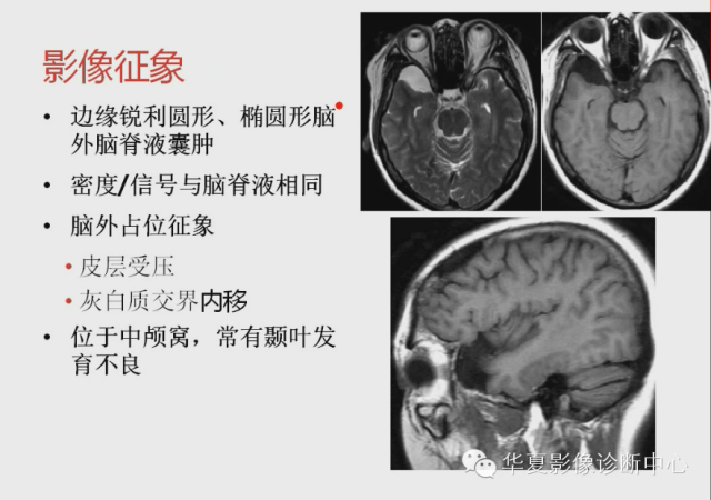 千万别把这些囊肿都诊断为蛛网膜囊肿