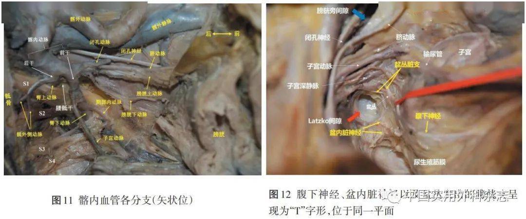 3 与llnd相关的血管解剖(图11,12 脐动脉是髂内动脉的第一分支,膀胱