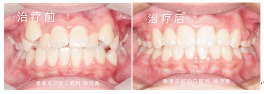 治疗|最佳时机别错过！孩子牙齿矫正