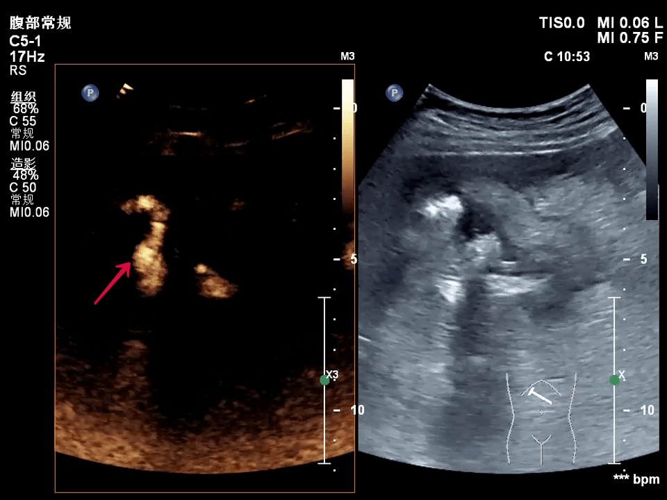超声|小结石引发的大麻烦——腹痛不能轻易忽视