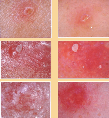 皮肤|刷酸=换脸？这个明星们超爱的百元刷酸好物搞定你的痘痘、闭口、黑头毛孔粗大还不怕烂脸！