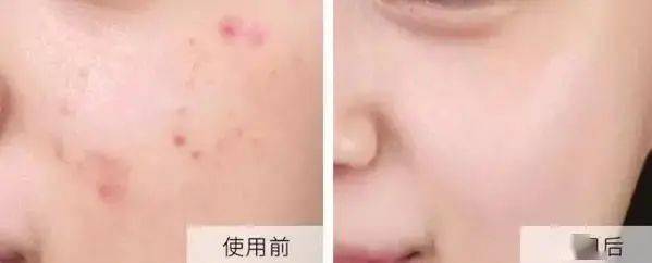 皮肤|刷酸=换脸？这个明星们超爱的百元刷酸好物搞定你的痘痘、闭口、黑头毛孔粗大还不怕烂脸！