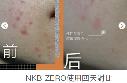 皮肤|刷酸=换脸？这个明星们超爱的百元刷酸好物搞定你的痘痘、闭口、黑头毛孔粗大还不怕烂脸！