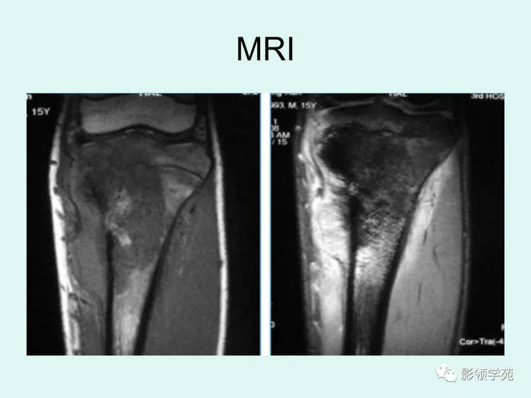 10种类型骨肉瘤影像学诊断