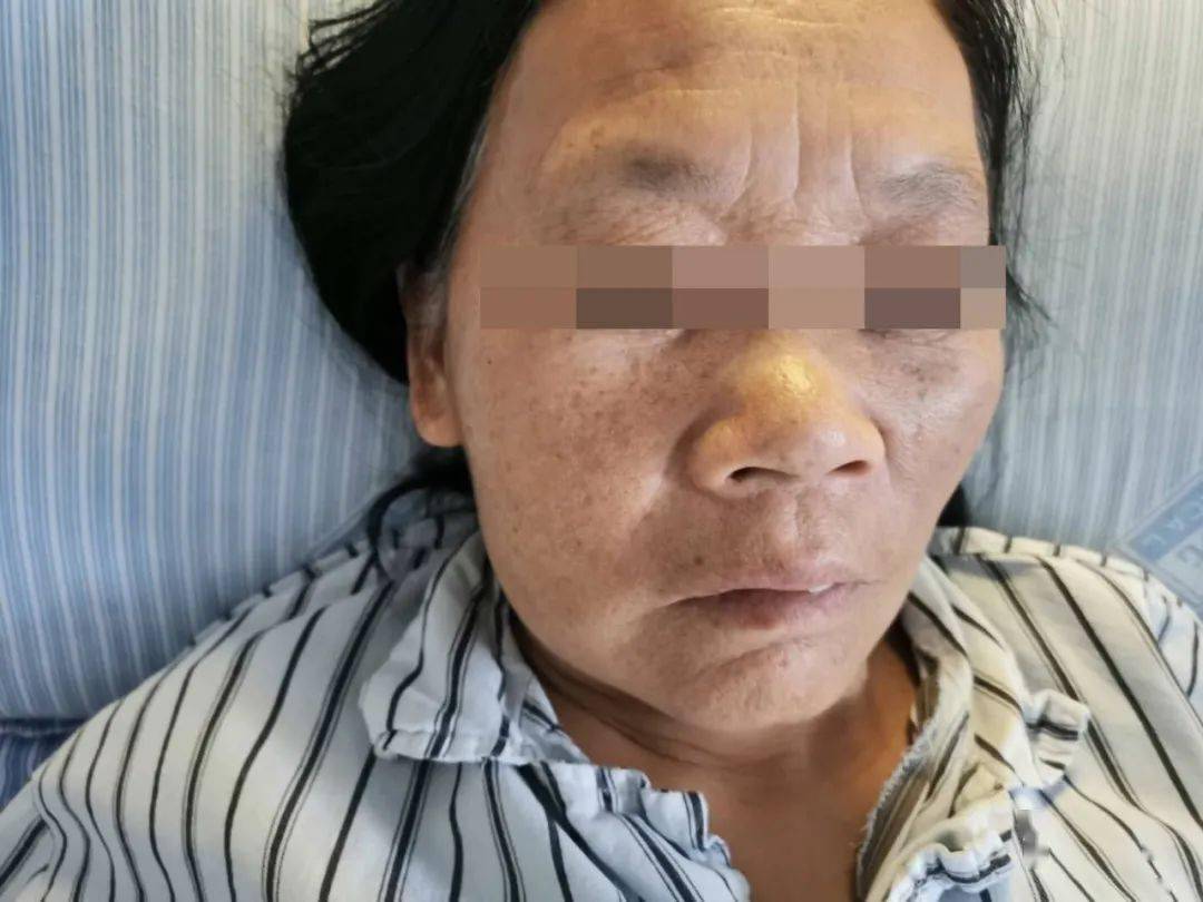 粉刺瘤是什么症状 df66ab58227841008eecac13b0536ac4.jpeg