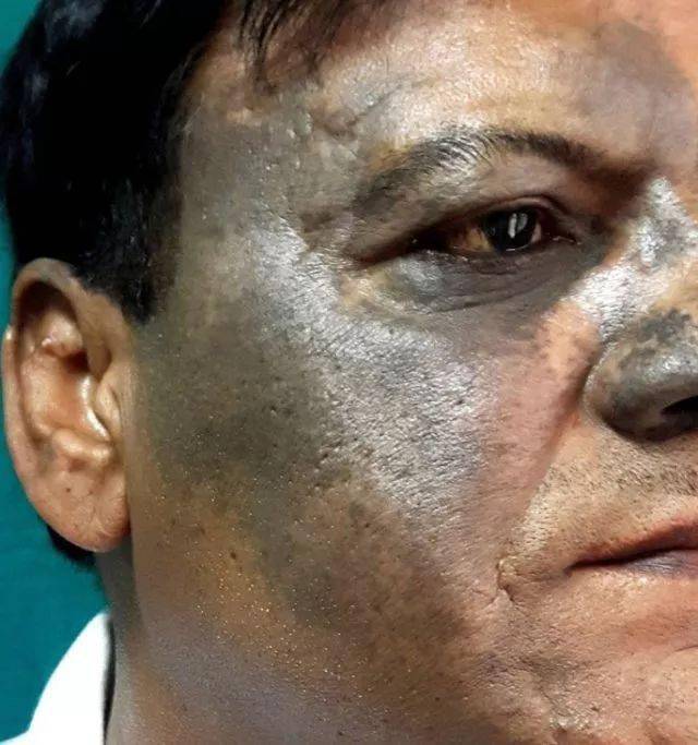 色素沉着图片有哪些 40b9877587f34bab965e4d925a65f056.jpeg