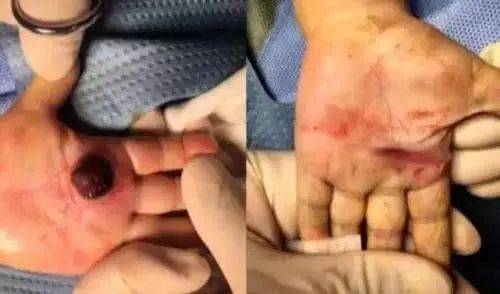 宝宝|爸妈听信偏方，一个决定害死了娃1岁孩子烫伤后