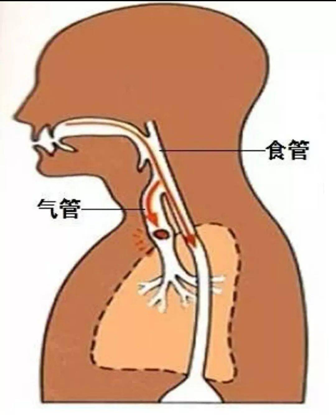 异物|又一个孩子被噎紧急送医！这套能救命的方法一定要学会！