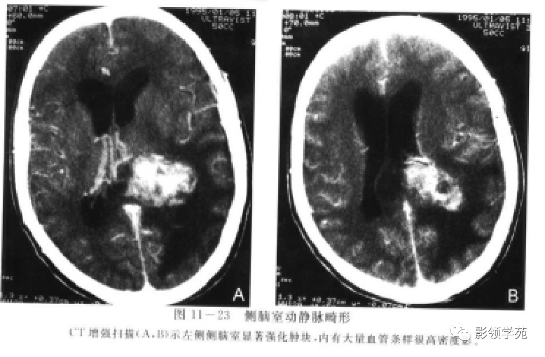 神经上皮囊肿可以位于脉络膜丛和脑室,偶尔也可以位于脑实质内.