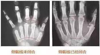孩子|决定最终身高！多长高10cm就靠它了孩子身上这条线
