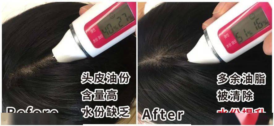 头发|头皮发痒，出油，还掉发？原来是你的洗发水没选好...