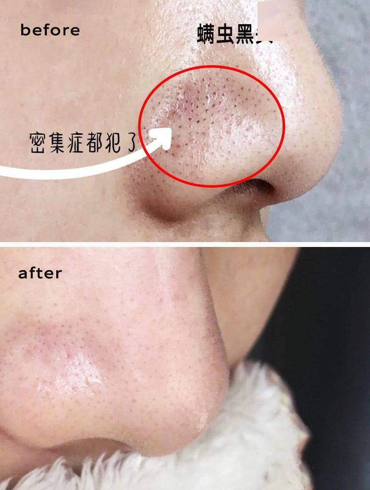 氨基酸|拒绝“螨虫脸”，5秒揉一揉，螨虫全出来了，痘痘黑头全没了！