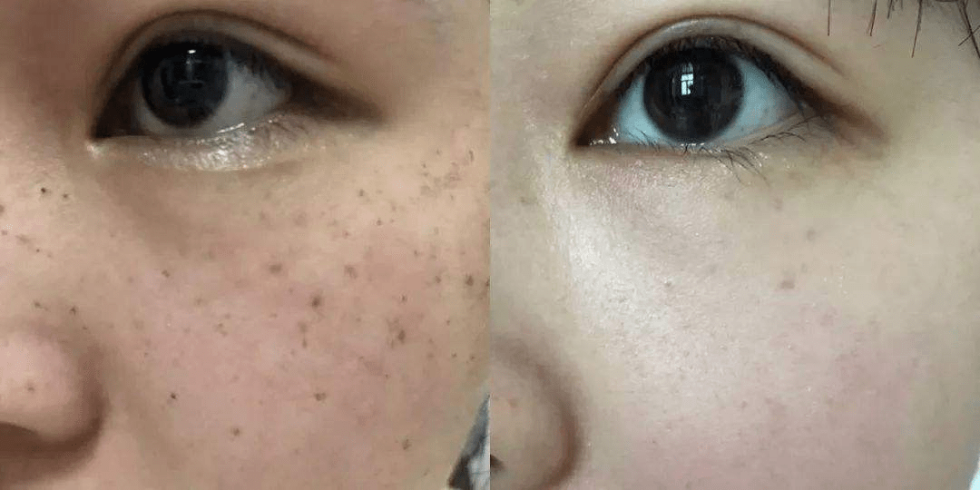 色斑|连抹7天,斑没了,皮肤真的白一度!