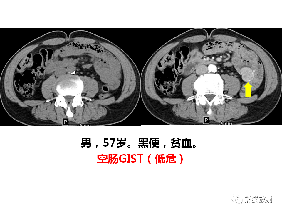 回肠末端 淋巴瘤小肠炎性纤维性息肉并肠套叠你想到了吗?有收获吗?