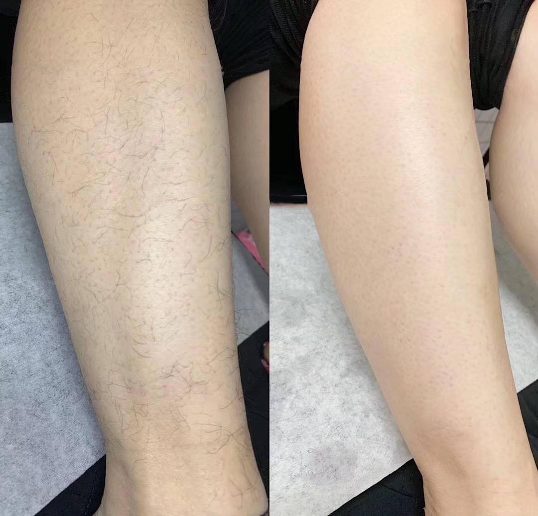 索兰|太狠！永久脱毛被我谈到99元，美白还嫩肤，秋季脱毛太机智了。