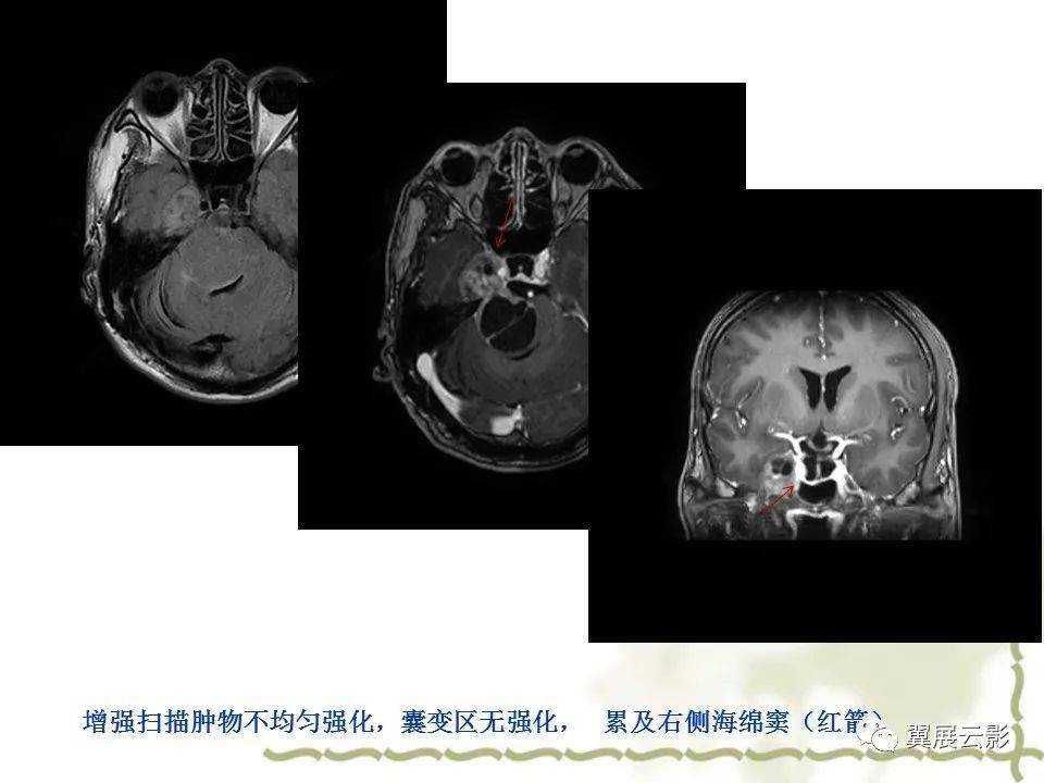 海绵窦解剖和12种常见疾病影像诊断