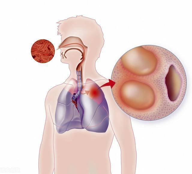 如何预防肺部问题 1d77333d30c04f87aec8bc4b8f84bc68.jpeg