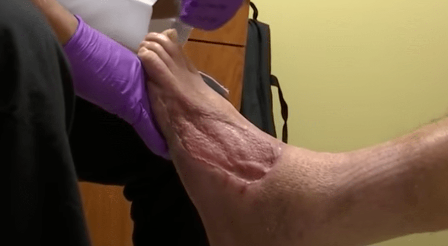 伤口|溃烂不愈的糖尿病足，竟然被「恶心」的蛆虫治好了？