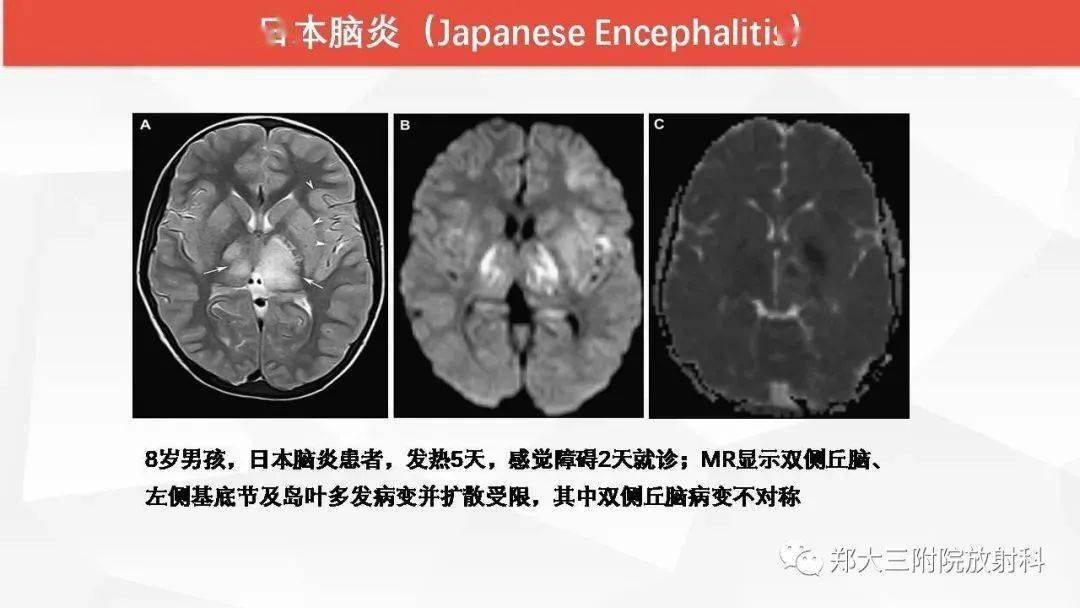 wernicke脑病的影像诊断