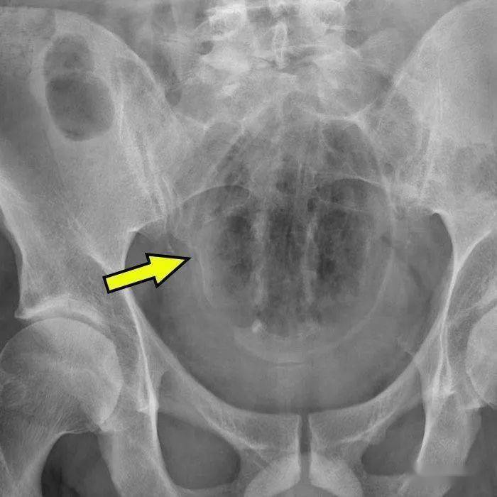 塞2斤金条藏8部手机…人类对肛门的探索太可怕了