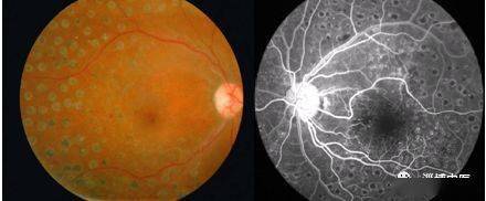 【临床医讯】眼底照相仪——有效检测糖尿病、高血压等疾病的视网膜病变