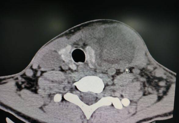 辅助检查:ct 提示左侧颈部巨大脓肿,已至咽后壁,椎旁.