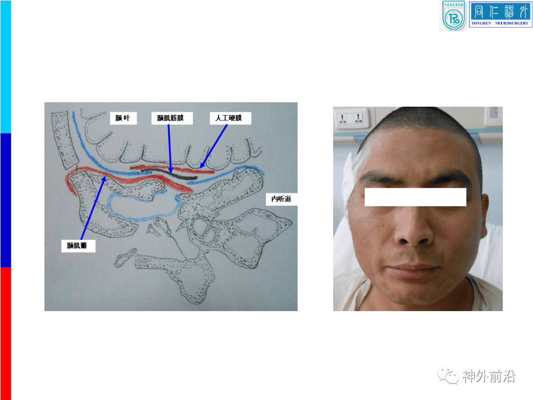 同仁颅面创伤容易误诊的脑脊液耳漏如何手术治疗康军