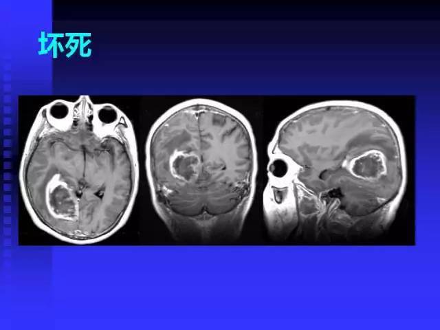 mr入门 | 头颅mri读片知识,需掌握!